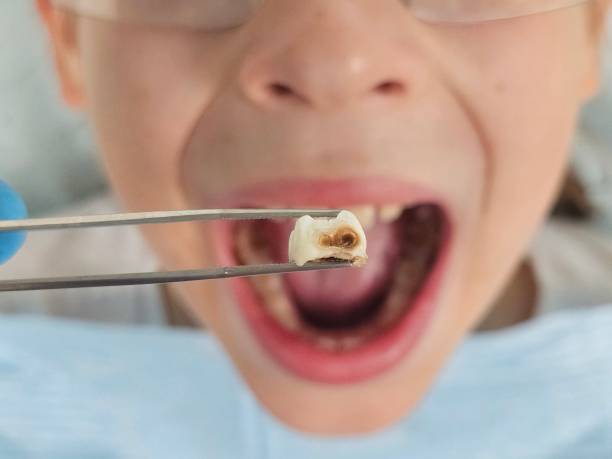 Best Emergency Tooth Extraction in Westport, WA
